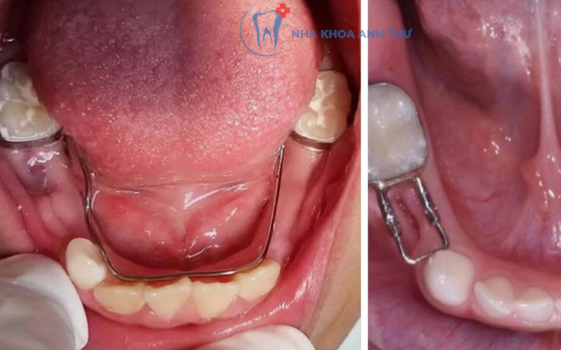 Nha-khoa-anh-thư-Hàm-giữ-khoảng-5