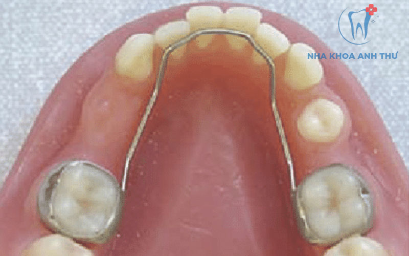 Nha-khoa-anh-thư-Hàm-giữ-khoảng-6