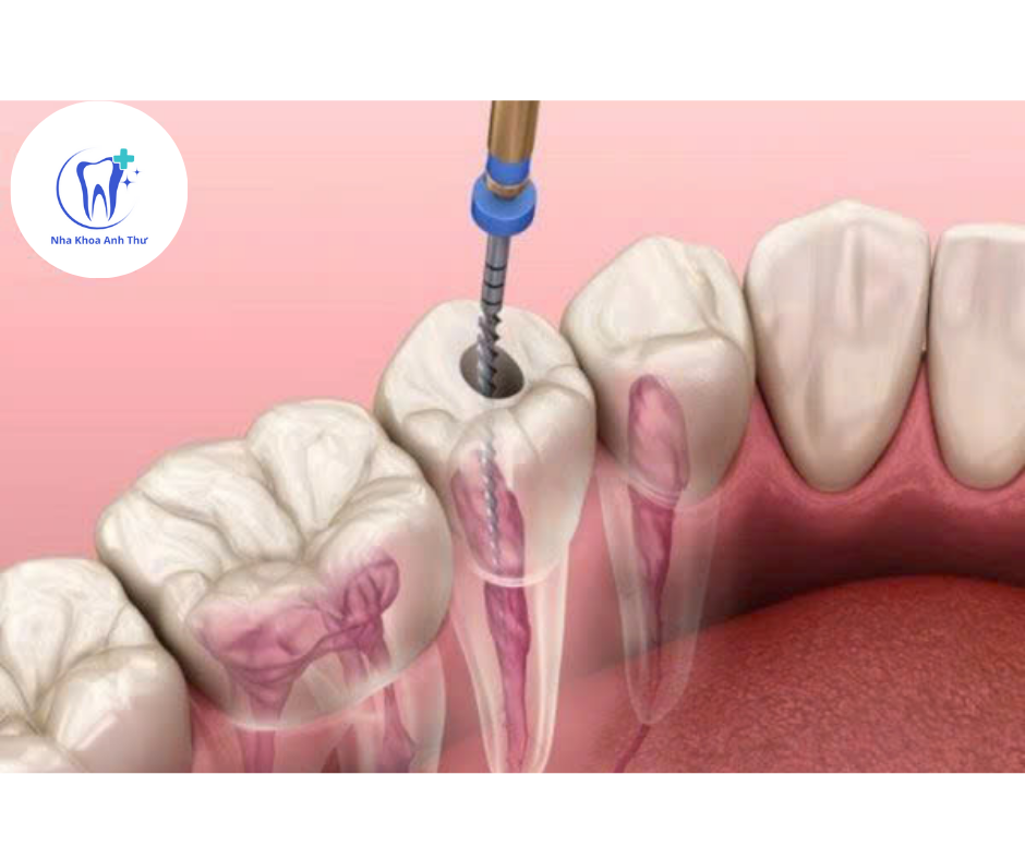 Điều trị tuỷ răng 