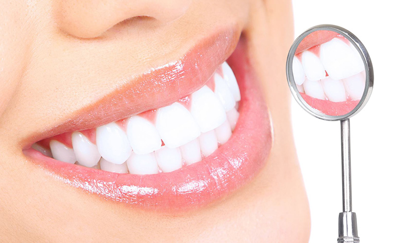 Lợi ích khi bọc răng sứ