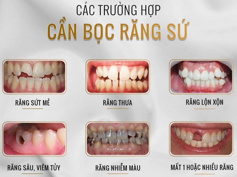 các trường hợp nên bọc răng sứ