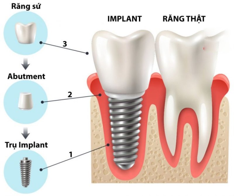 Cấu taọ răng Implant
