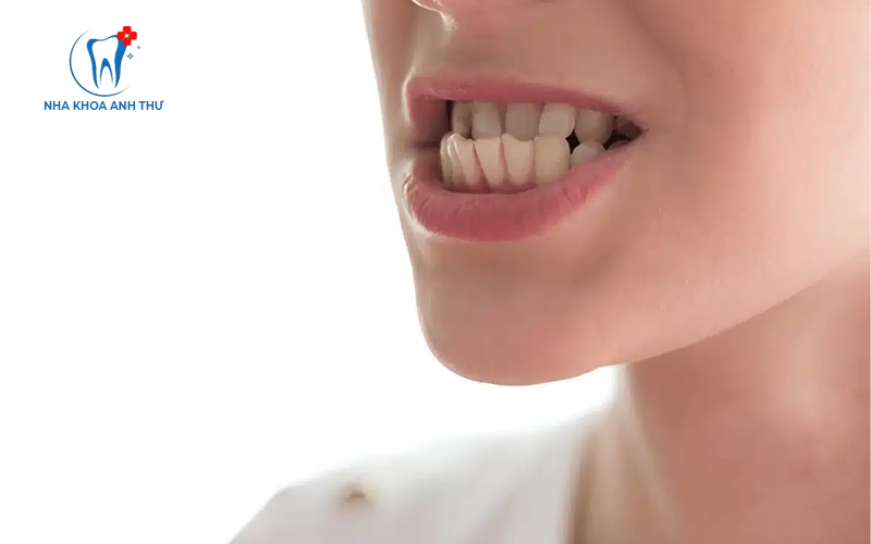 khop-can-nguoc-nha-khoa-anh-thu-2