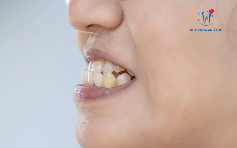 khop-can-nguoc-nha-khoa-anh-thu-3