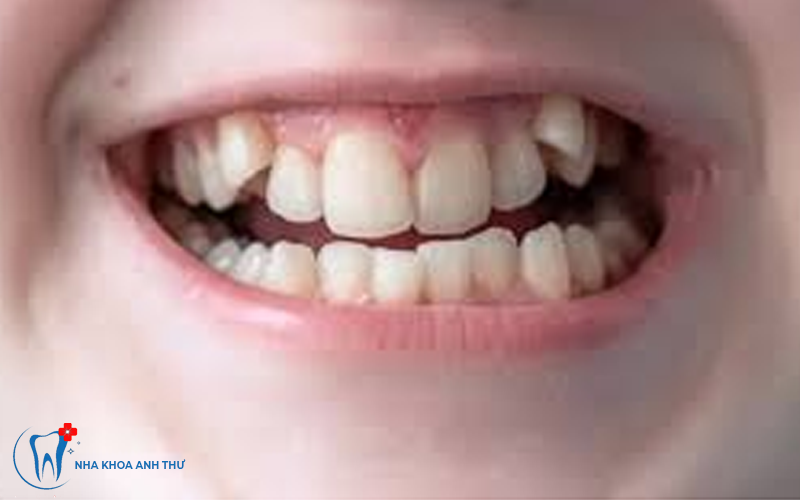 khop-can-nguoc-nha-khoa-anh-thu-4