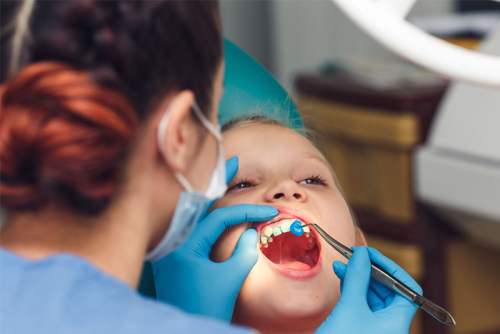 GIẢI PHÁP PHÒNG NGỪA SÂU RĂNG Ở TRẺ EM BẰNG THUỐC BÔI BỀ MẶT RĂNG