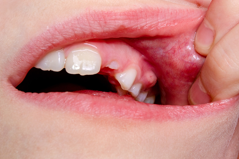 nha-khoa-anh-thu-ap-xe-rang-4