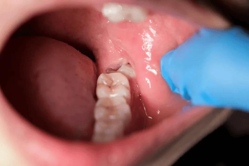 nha-khoa-anh-thu-ap-xe-rang-6