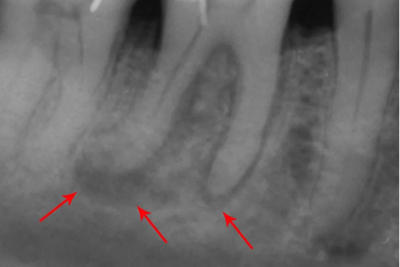 nha-khoa-anh-thu-ap-xe-rang-7