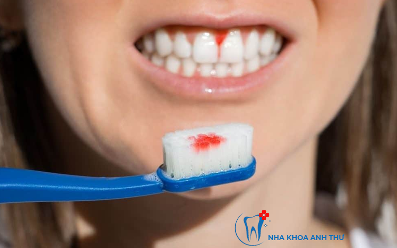 nha-khoa-anh-thu-canh-bao-rang-mieng-5