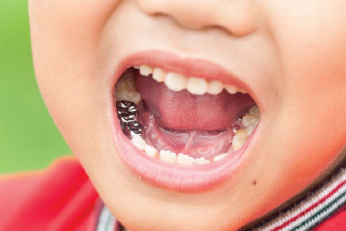 CHỤP THÉP CÓ SẴN: BƯỚC TIẾN ĐỘT PHÁ TRONG ĐIỀU TRỊ PHỤC HỒI RĂNG SỮA