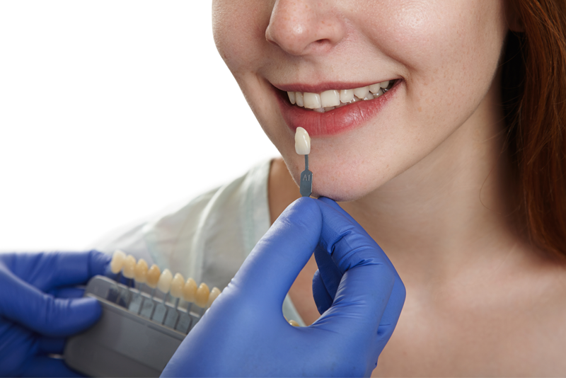 nha khoa anh thư dán sứ veneer 1