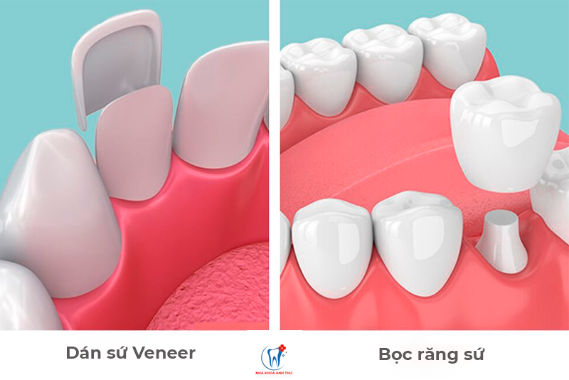 nha khoa anh thư dán sứ veneer 3