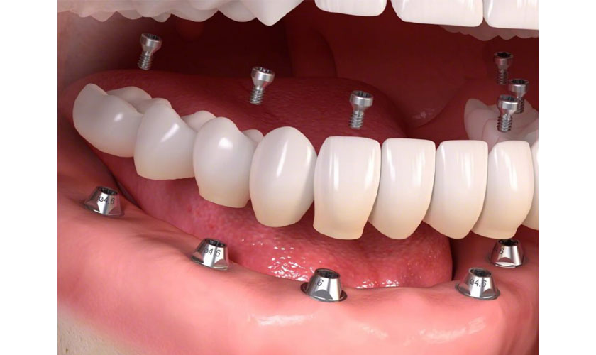 Những lưu ý khi sử dụng phương pháp trồng răng Implant