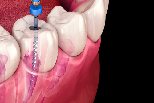 ĐIỀU TRỊ TỦY RĂNG TẠI NHA KHOA ANH THƯ SƠN TÂY