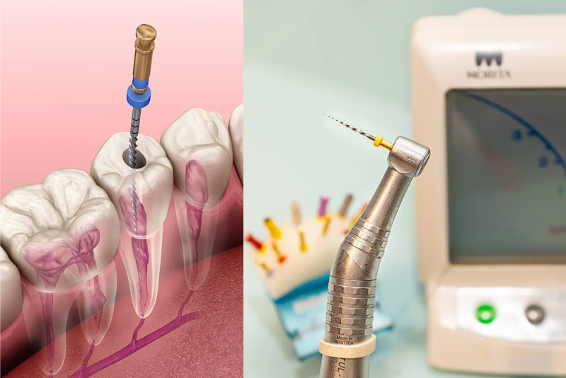 nha-khoa-anh-thu-dieu-tri-tuy-2