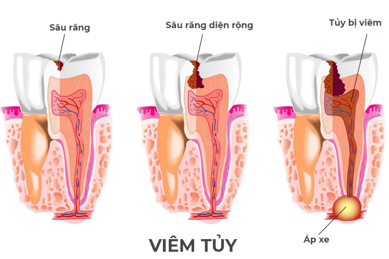 nha khoa anh thư điều trị viêm tủy 5