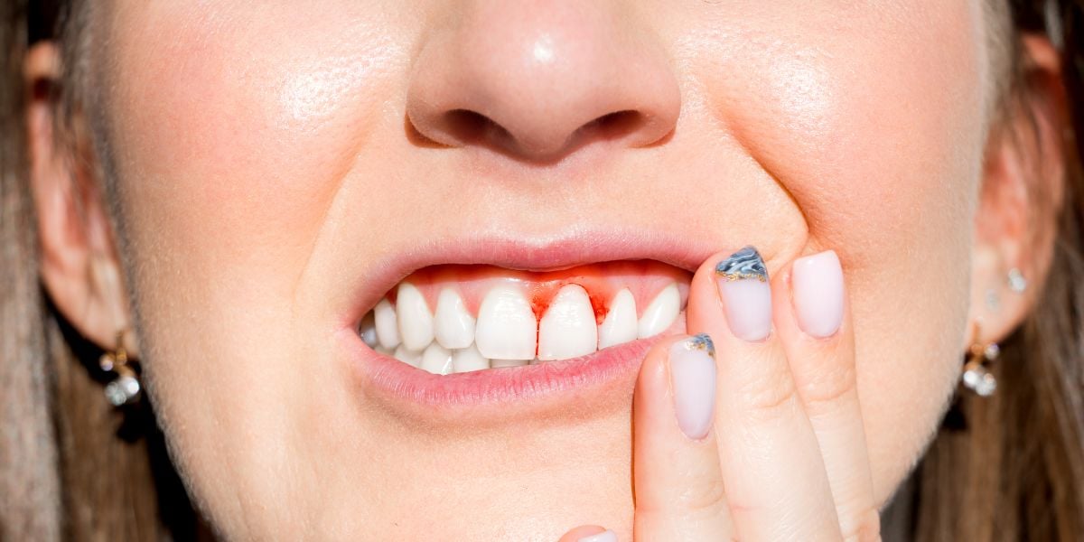 nha khoa anh thư điều trị viêm lợi 03