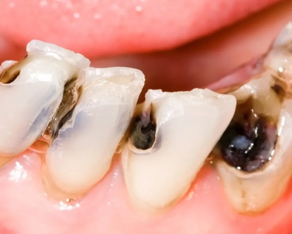 nha khoa anh thư điều trị viêm tủy răng 12