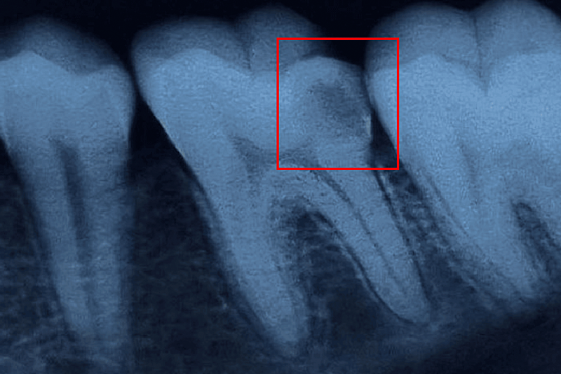 nha khoa anh thư điều trị viêm tủy răng 14