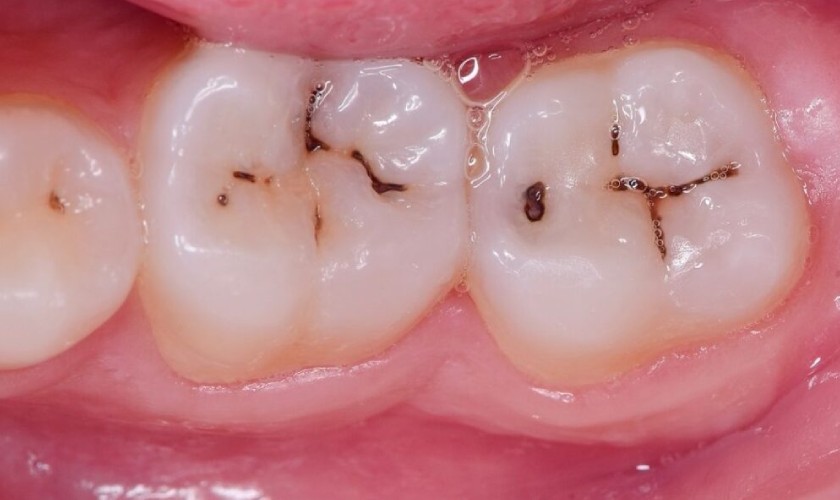 Hình ảnh mặt răng bị sâu