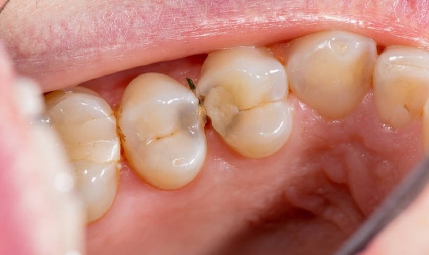 Hình ảnh kẽ răng bị sâu