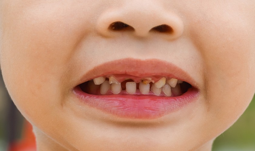 Hình ảnh răng cửa bị sâu