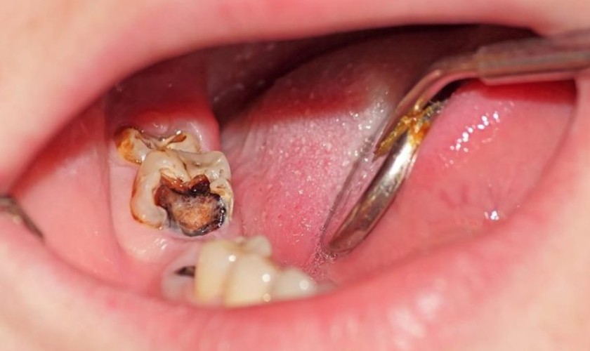 Hình ảnh răng hàm lớn bị sâu