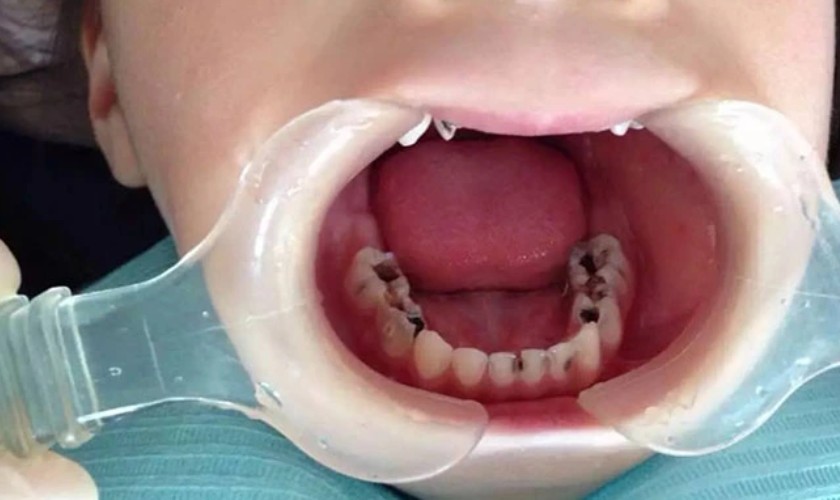 Hình ảnh bị sâu nhiều răng