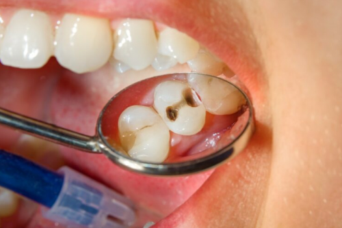 SÂU RĂNG Ở TRẺ EM: NGUYÊN NHÂN, TRIỆU CHỨNG VÀ CÁCH PHÒNG NGỪA?