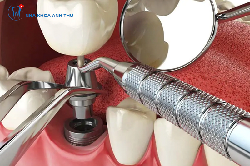 nha-khoa-anh-thu-implant-han-quoc-1