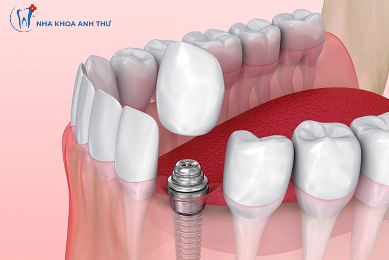 nha-khoa-anh-thu-implant-han-quoc-2