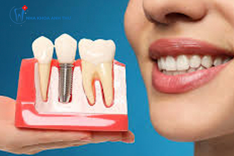 nha-khoa-anh-thu-implant-han-quoc-3