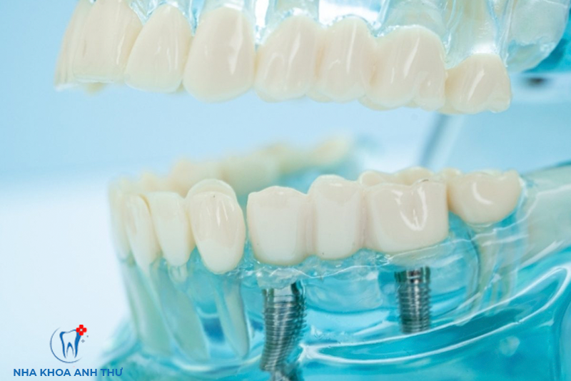 nha-khoa-anh-thu-implant-thuy-si-1