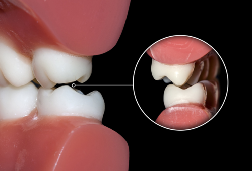 KHỚP CẮN ĐỐI ĐỈNH: NHẬN BIẾT, NGUYÊN NHÂN VÀ PHƯƠNG PHÁP XỬ LÝ