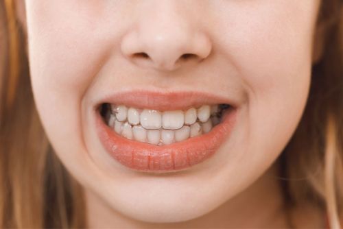 KHỚP CẮN NGƯỢC: TÌNH TRẠNG VÀ CÁC GIẢI PHÁP ĐIỀU TRỊ HIỆU QUẢ