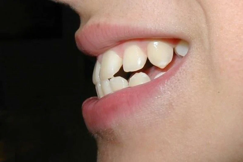 /nha-khoa-anh-thu-khop-can-nguoc-2