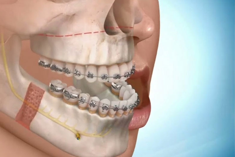 /nha-khoa-anh-thu-khop-can-nguoc-3