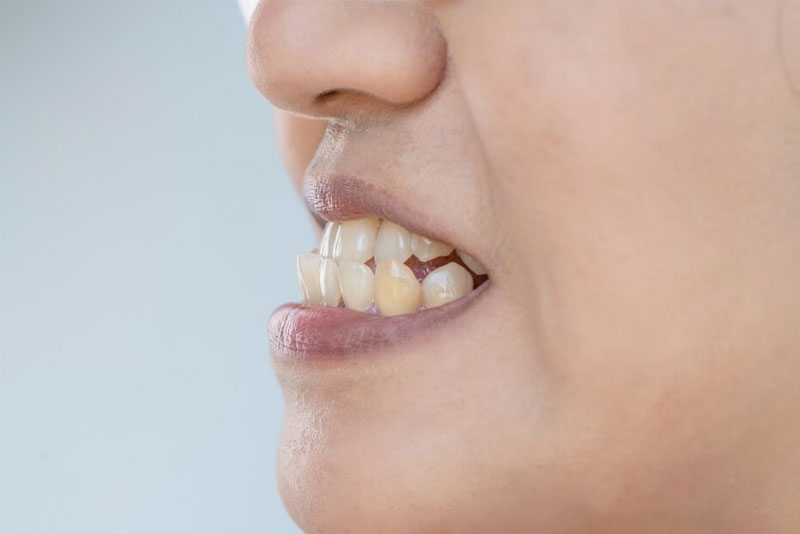 nha-khoa-anh-thu-khop-can-nguoc-4