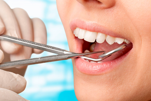 LẤY CAO RĂNG TẠI NHA KHOA ANH THƯ