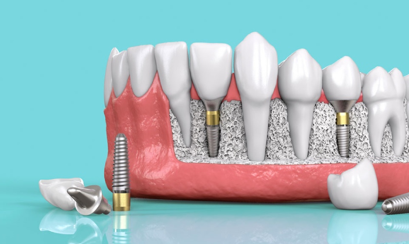 Lợi ích khi  sử dụng trồng răng Implant