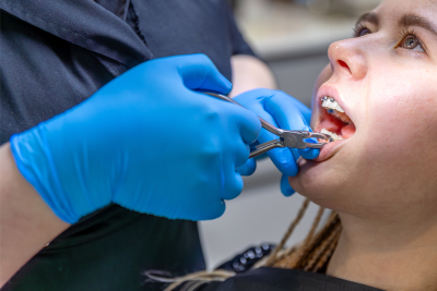 NHỔ RĂNG VÀ THỜI GIAN HẾT CHẢY MÁU: NHỮNG ĐIỀU CẦN BIẾT