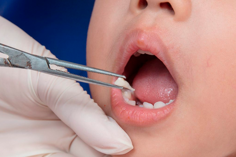 nha-khoa-anh-thu-nho-rang-khon-6