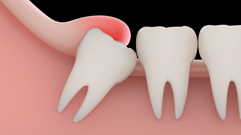 nhưng điều cần biết khi nhổ răng số 8