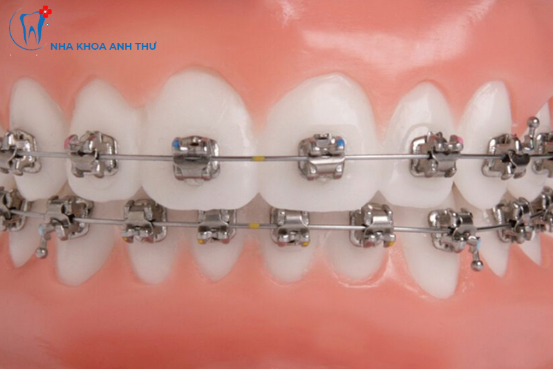 nha-khoa-anh-thu-nieng-rang-mac-cai-tu-buoc-1