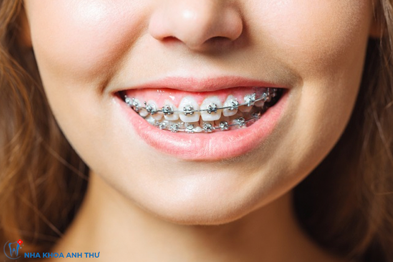 nha-khoa-anh-thu-nieng-rang-mac-cai-tu-buoc-2