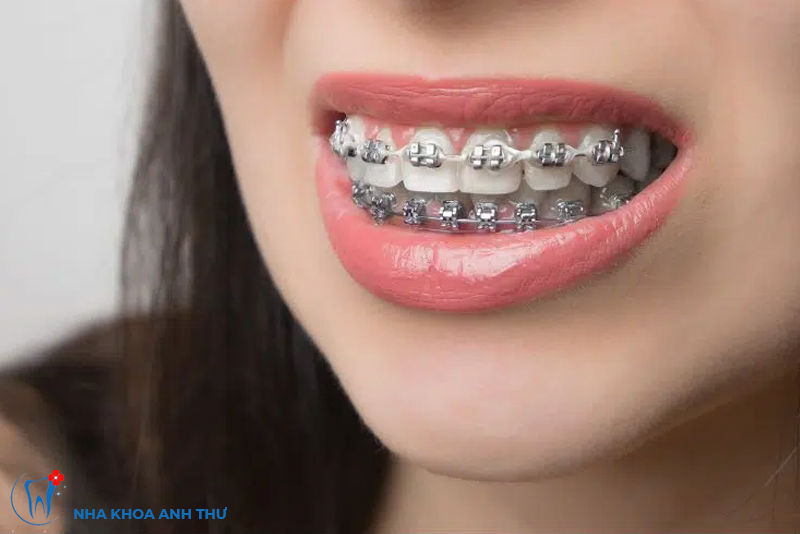 nha-khoa-anh-thu-nieng-rang-mac-cai-tu-buoc-3