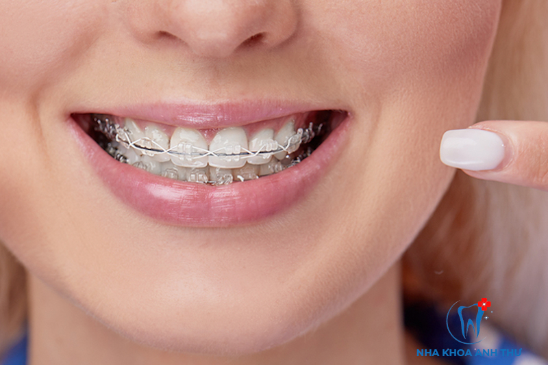 nha-khoa-anh-thu-nieng-rang-mac-cai-tu-buoc-5