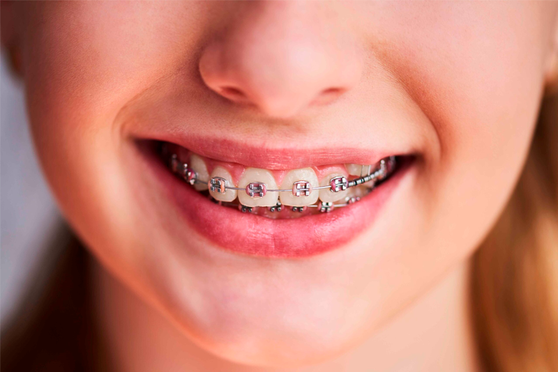 nha khoa anh thư niềng răng mắc cài 2