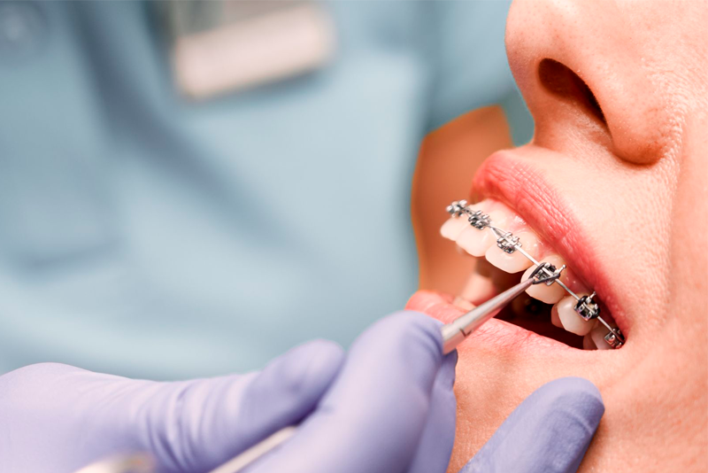 nha khoa anh thư niềng răng mắc cài 3